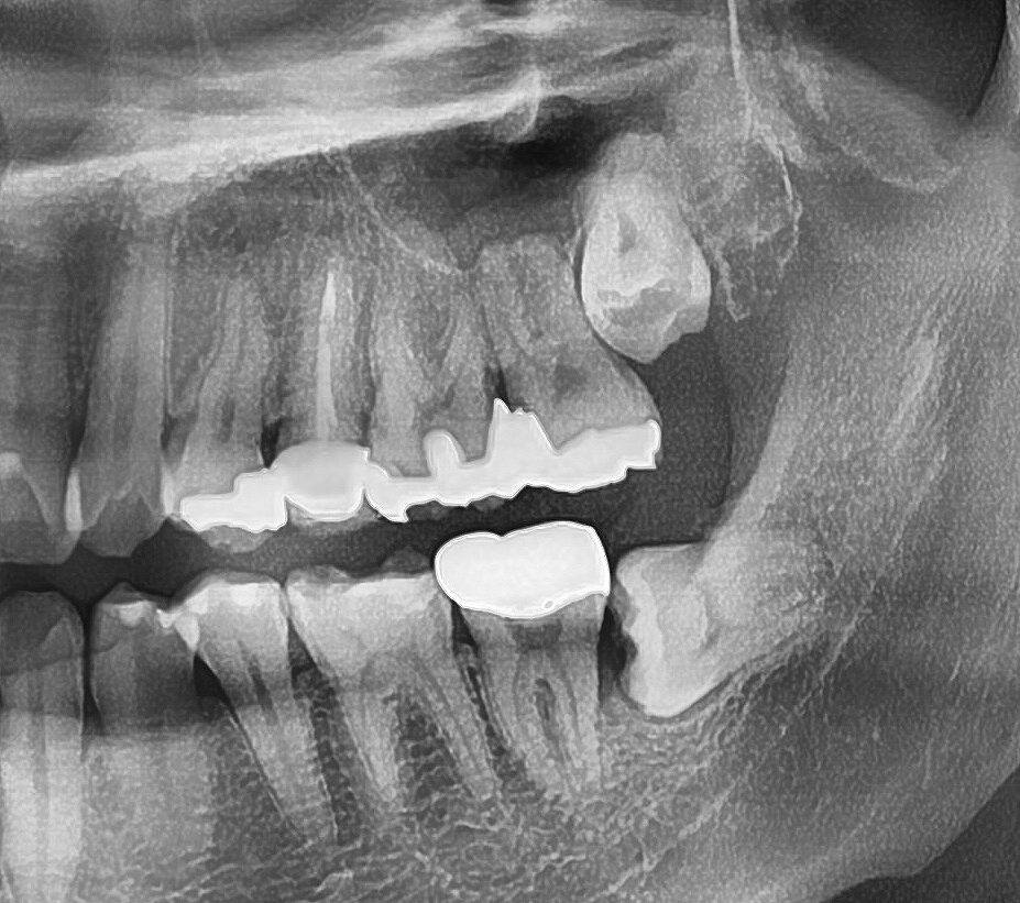사랑니 당일 발치 가능한 곳, 강남역치과 레옹! 관련 이미지 3