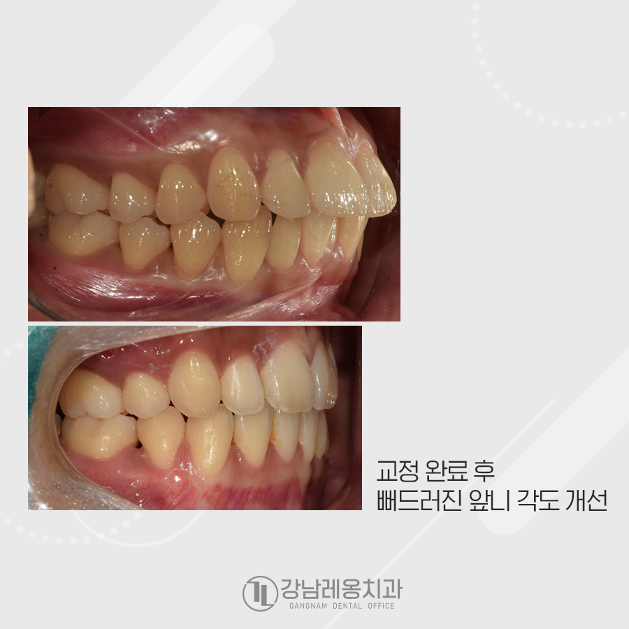 강남레옹치과 치아 교정, 돌출입 두가지 케이스 관련 이미지 8