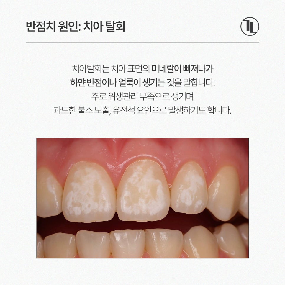 Must Check Before Treating White Spots / Icon Resin Features, Process, and Precautions / Gangnam Leen Dental Clinic image 2