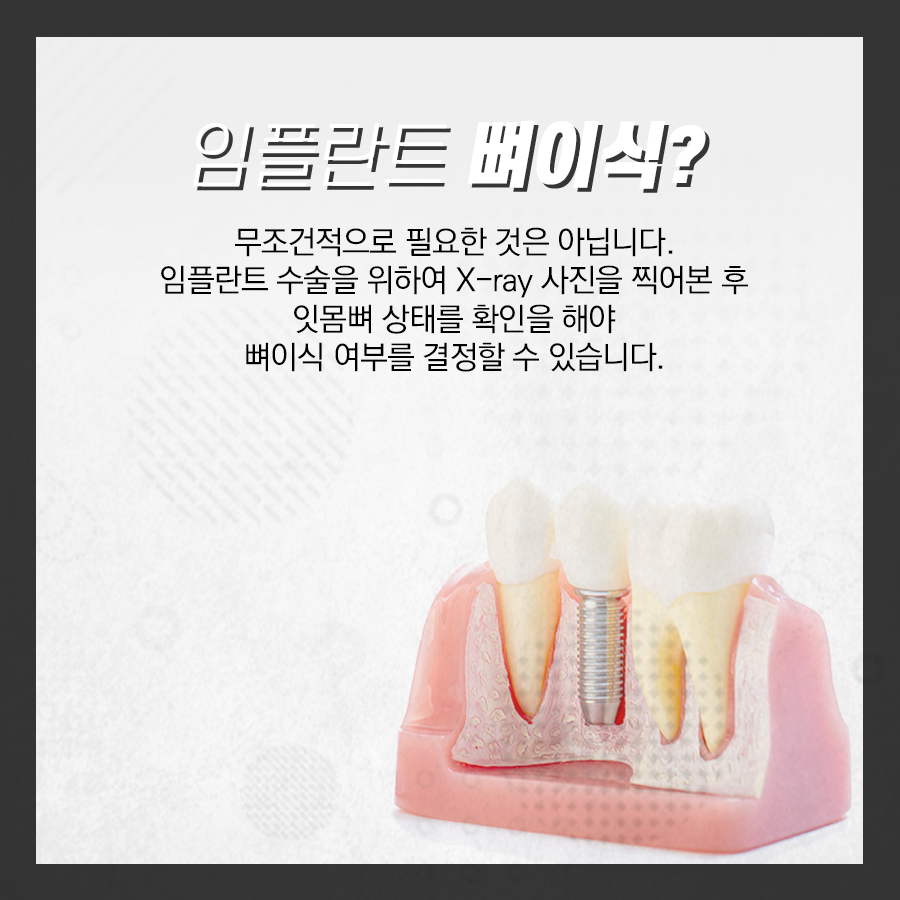 강남레옹치과 뼈이식 임플란트 수술, 어떤 경우에 해야 될까? 관련 이미지 2