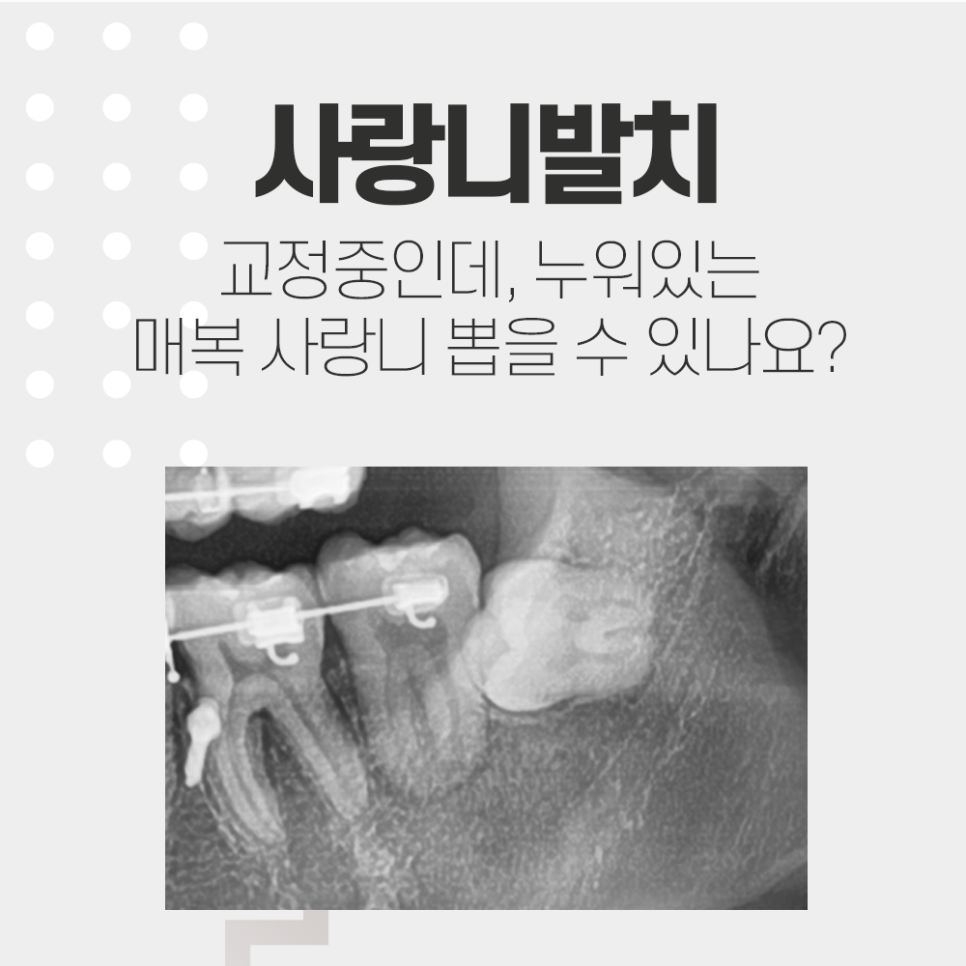 교정 중 수평매복사랑니 발치, 강남레옹치과에서 관련 이미지 1