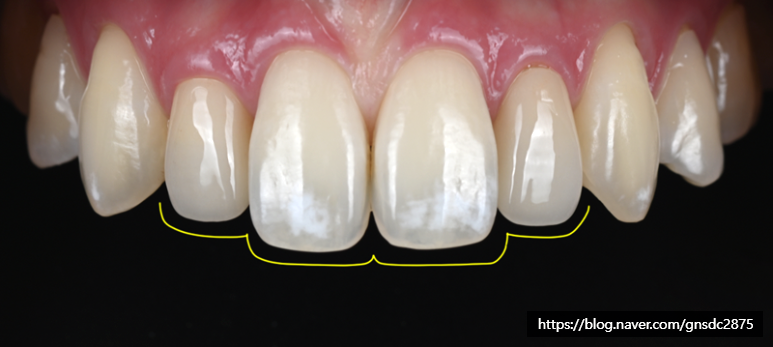 깨진 앞니 길이가 긴 앞니, 법랑질 성형 알아보기🔎 / 강남레옹치과의원 관련 이미지 4