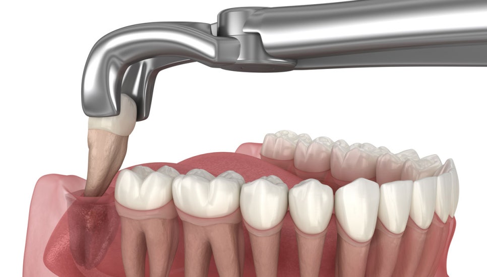 Flying After Wisdom Tooth Extraction? When Can You Exercise After Extraction? / Gangnam Station Wisdom Teeth—Gangnam Leon Dental Clinic image 2