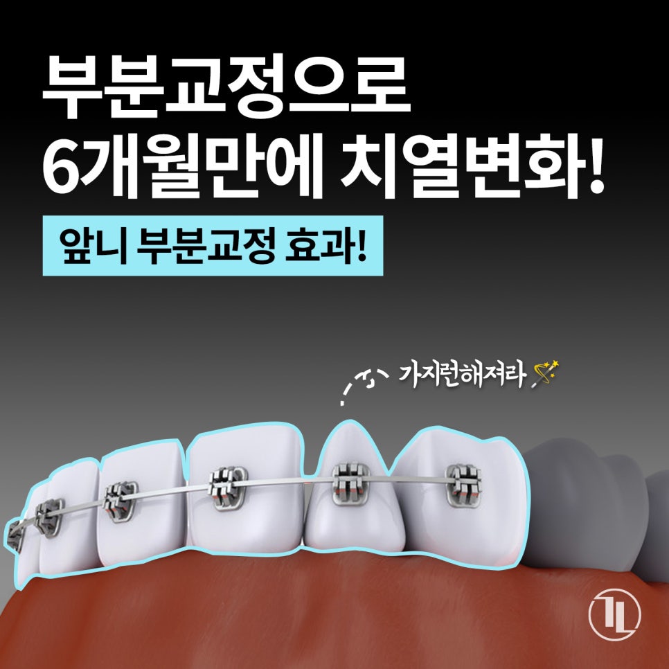 앞니 부분교정, 6개월 만에 치열 변화! 진짜 효과 있을까? / 강남레옹치과 관련 이미지 1