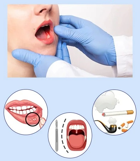 잇몸담배 시대, 니코틴 파우치 치과에서 경고하는 이유는? / 강남레옹치과 관련 이미지 5