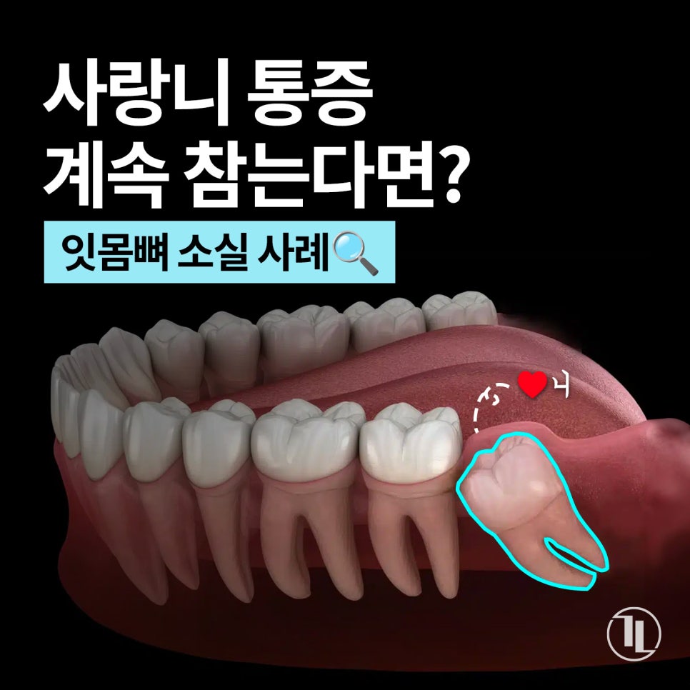 사랑니 통증, 약 먹으며 방치하면 안되는 이유! 실제 방치 사례🔍 / 강남레옹치과 관련 이미지 1