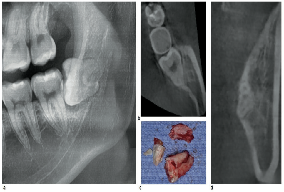 아래 매복 사랑니 발치 합병증에 관한 논문 연구! 박영민, 김영삼 원장님 관련 이미지 5
