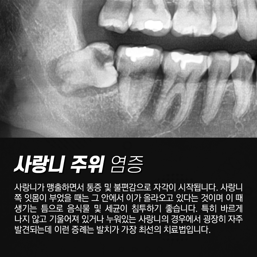 잇몸 부었을 때, 그 질환 원인과 치료법은 무엇일까요?? 관련 이미지 3