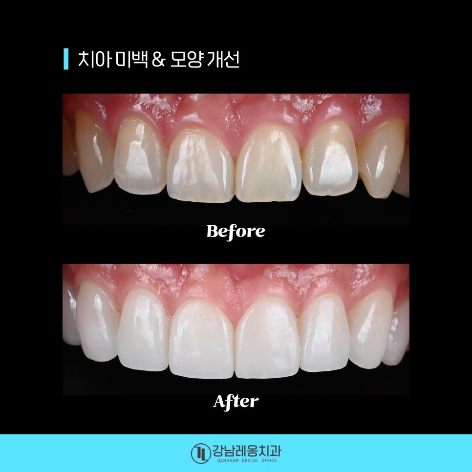 최소삭제 라미네이트 &lsquo;뉴티스&rsquo;의 시술 후 관리방법은? / 양치질, 치실 사용방법 / 강남레옹치과 관련 이미지 6