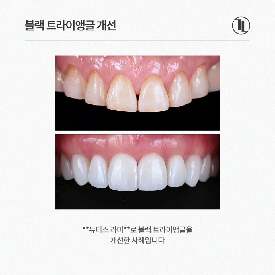앞니 공간 블랙 트라이앵글 개선, 강남레옹치과 앞니치료 뉴티스 관련 이미지 4