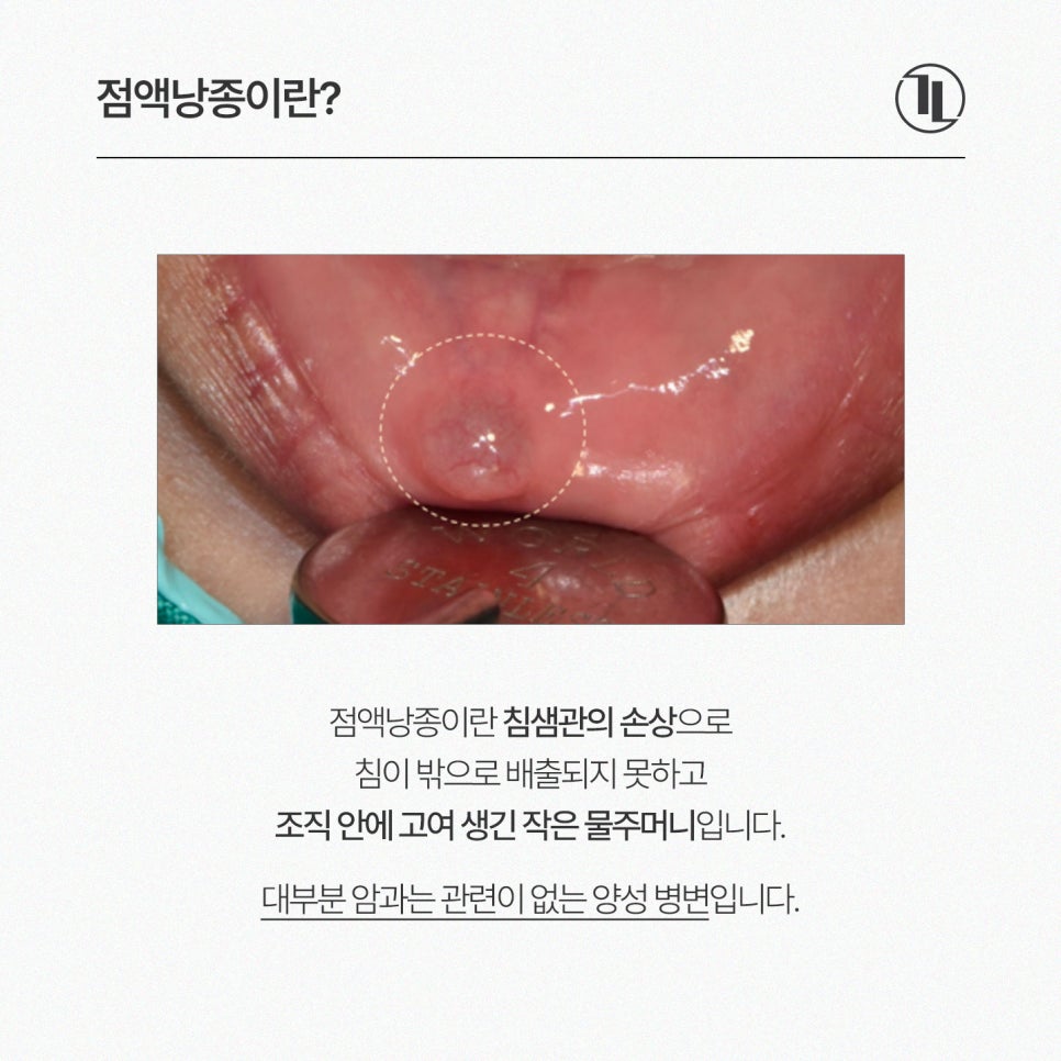 입술 안쪽에 말랑한 멍울, 그냥 둬도 괜찮을까? / 점액낭종 특징과 치료 / 강남레옹치과 관련 이미지 2