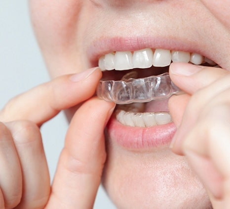 치과의사가 직접 경험한 인비절라인 특징과 진행과정👨&zwj;⚕️ / 강남레옹치과 관련 이미지 4