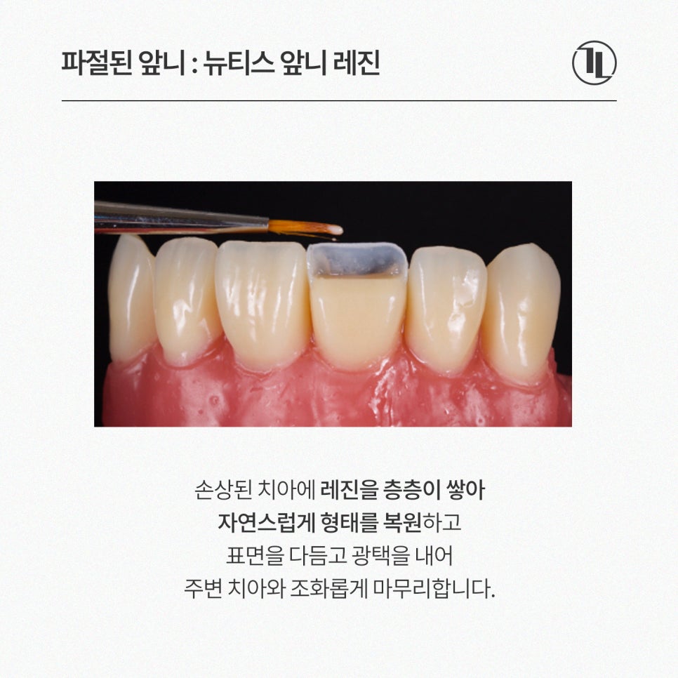 깨지고 하얗게 얼룩진 앞니, 라미네이트 대신 뉴티스 솔루션 / 강남레옹치과 관련 이미지 3