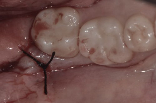 사랑니 발치 후 관리 & 회복 과정 한 눈에 보기👀! / 강남레옹치과 관련 이미지 2