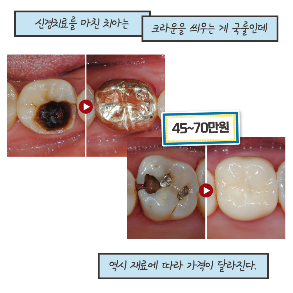 냐폴레옹 치과툰) 사람마다 다른 충치치료 비용 관련 이미지 10