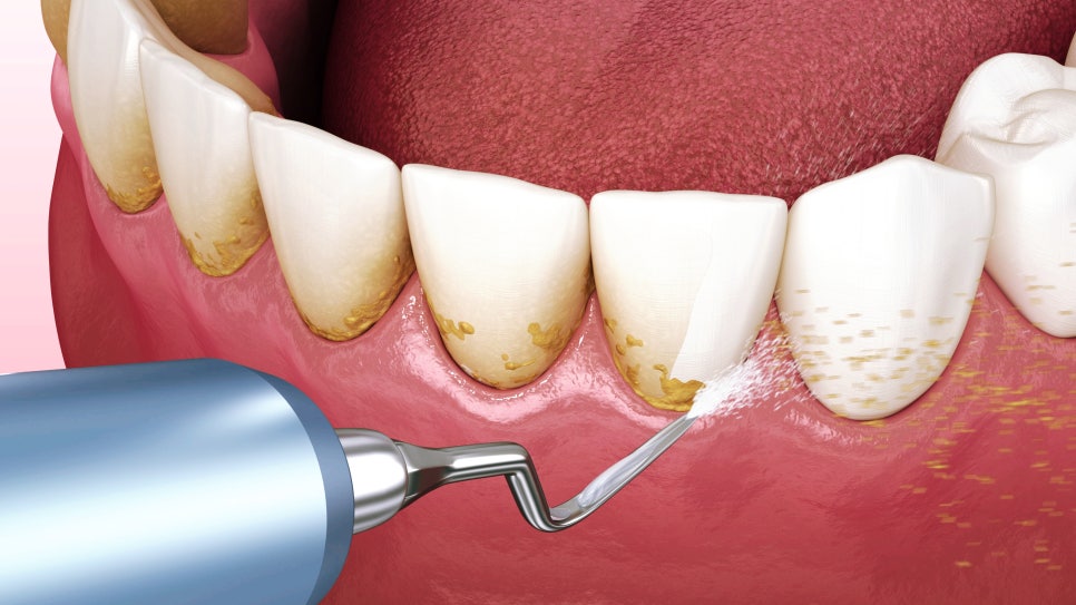 잇몸과 치아 사이 공간 &lsquo;블랙트라이앵글&rsquo;을 무시하면 안되는 이유! / 생기는 원인과 해결 방법 / 강남레옹치과 관련 이미지 6