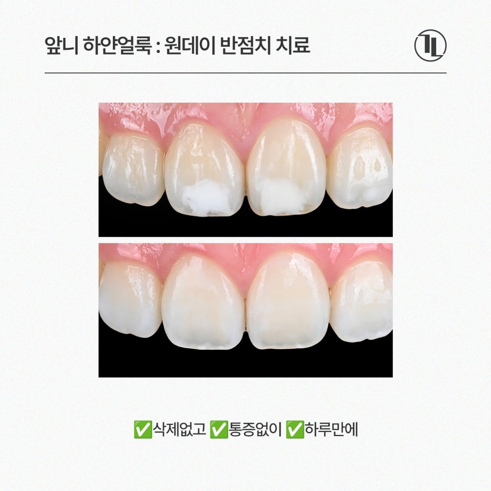 앞니 하얀얼룩, 하루만에 제거! 뉴티스 반점치 치료 / 강남레옹치과 관련 이미지 3