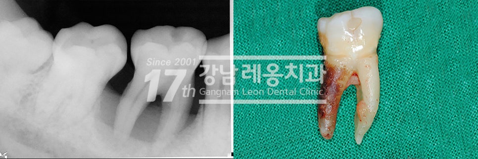 올바른 잇솔질이 왜 중요한지 예방중심 강남역치과의 설명 관련 이미지 6