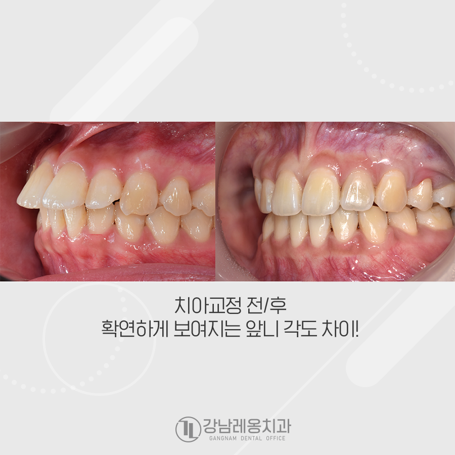뻐드러진 앞니 각도를 조절하여 돌출입 교정 관련 이미지 4