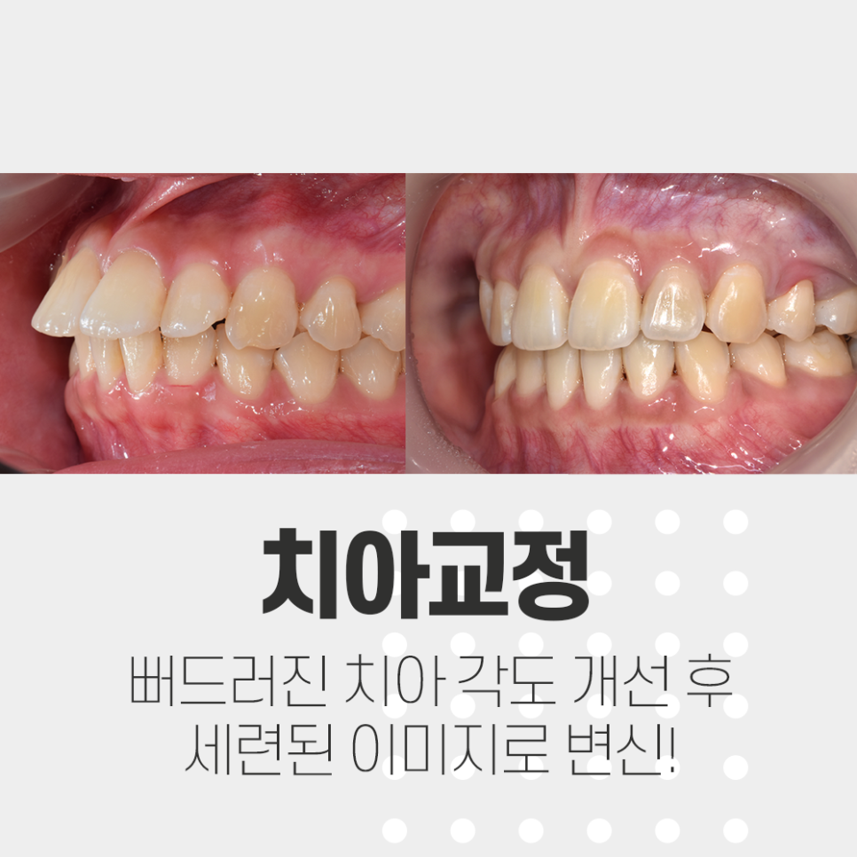 뻐드러진 앞니 각도를 조절하여 돌출입 교정 관련 이미지 1