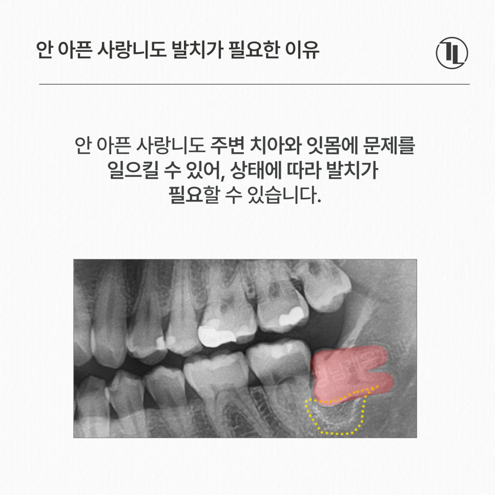사랑니 안 아픈데 꼭 뽑아야 될까요?발치가 필요한 경우 / 강남레옹치과 관련 이미지 2