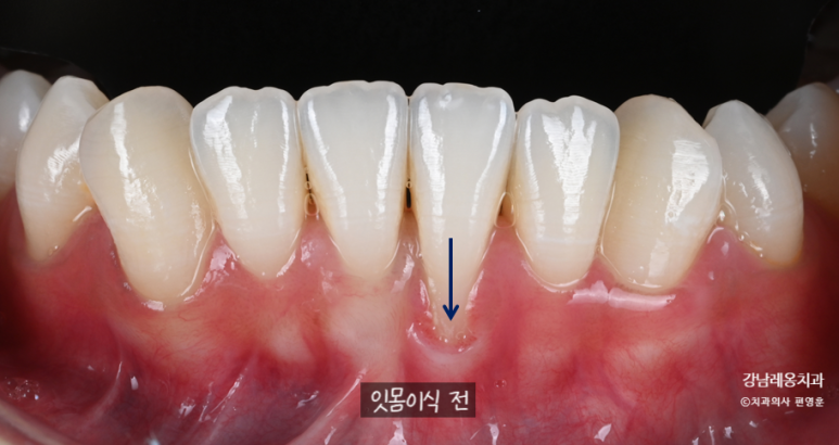 Gum Recession: Can It Expose the Tooth Roots? Before and After Gum Grafting! / Gangnam Leon Dental Clinic image 5