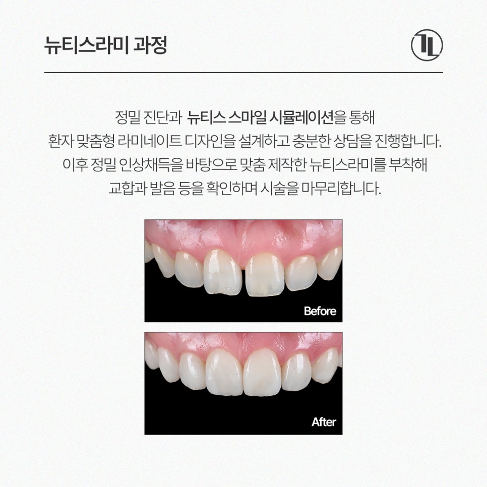 앞니 벌어짐, 정중이개 뉴티스라미 / 강남레옹치과 뉴티스 스마일 시뮬레이션 관련 이미지 10