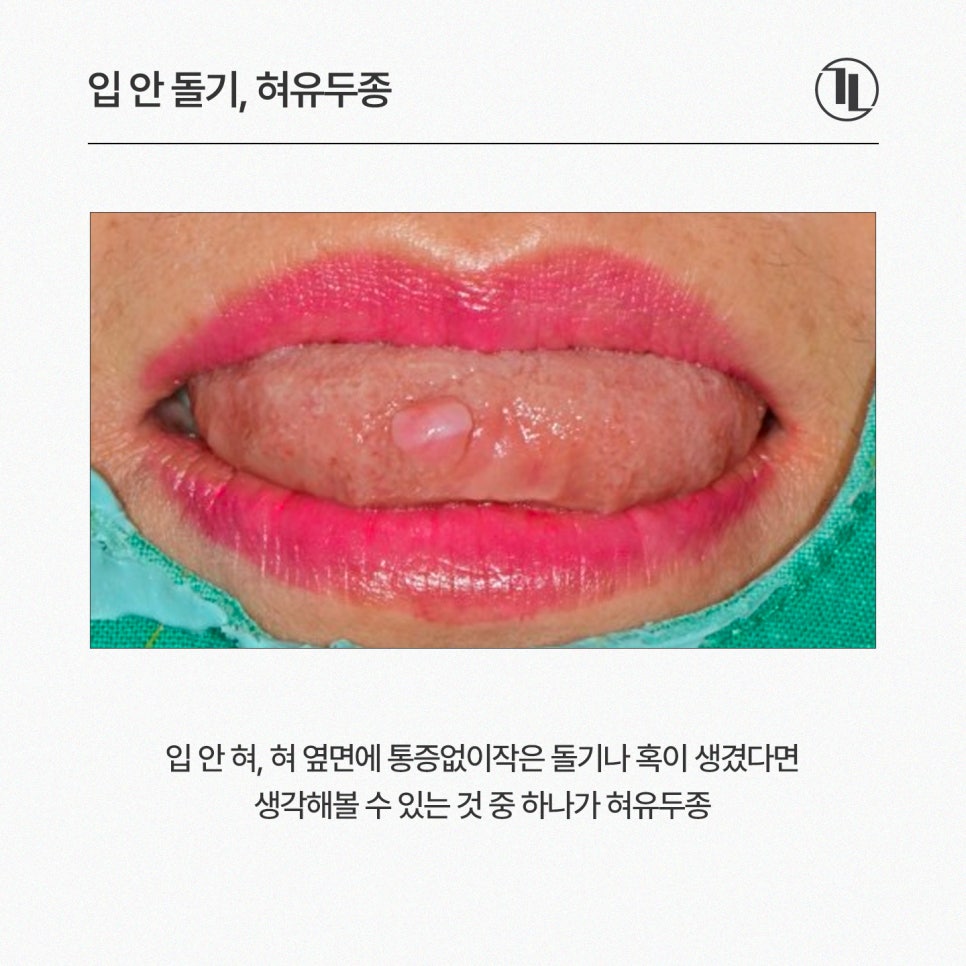 입안 피물집, 물혹, 혓바늘, 혀돌기(유두종) 원인 및 치료 / 강남레옹치과 관련 이미지 5