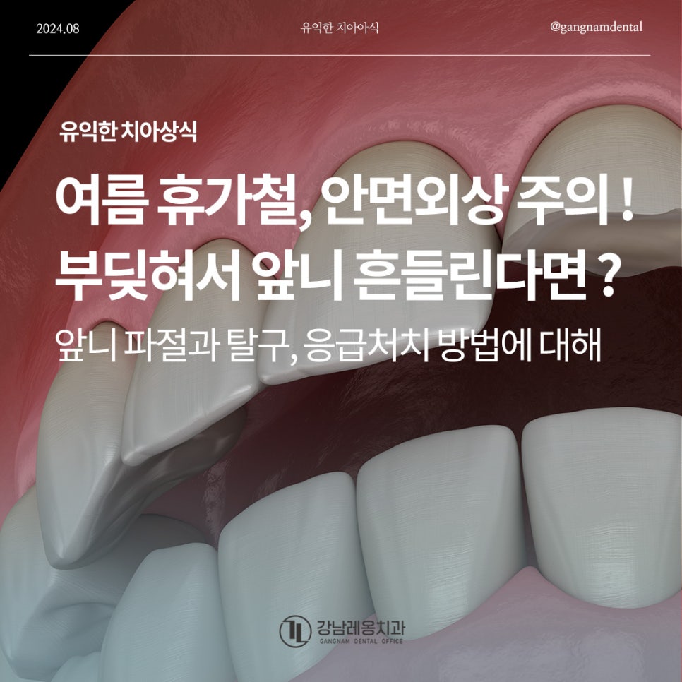 여름 휴가철, 안면외상 주의! 부딪혀서 앞니 흔들림 / 치아가 깨지거나 부러지면 제일 먼저 해야할 대처법은? / 치아 파절과 탈구 비교 관련 이미지 1