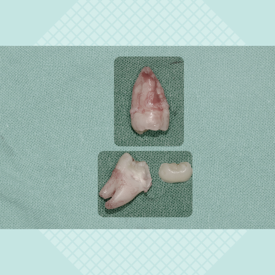 매복 사랑니발치 비용, 강남레옹치과 증례를 보며 알아봐요. 관련 이미지 5