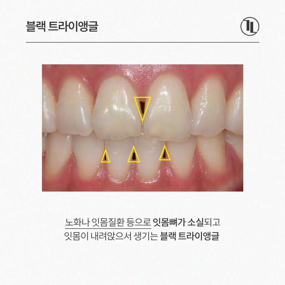앞니 공간 블랙 트라이앵글 개선, 강남레옹치과 앞니치료 뉴티스 관련 이미지 2