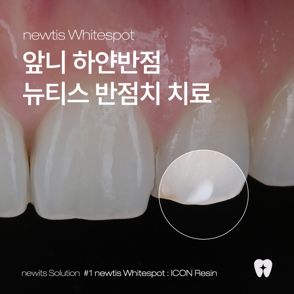 뉴티스 반점치 치료✨ 최다 임상적용, 반점치 제거 아이콘레진 / 강남레옹치과 관련 이미지 1
