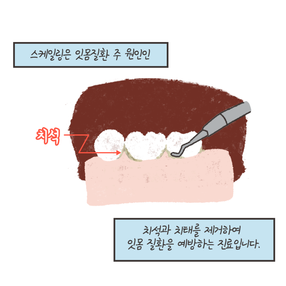 냐폴레옹 치과툰) 발치 위험을 막아주는데 보험도 되는, 갓성비 치과진료가 있다? 관련 이미지 6