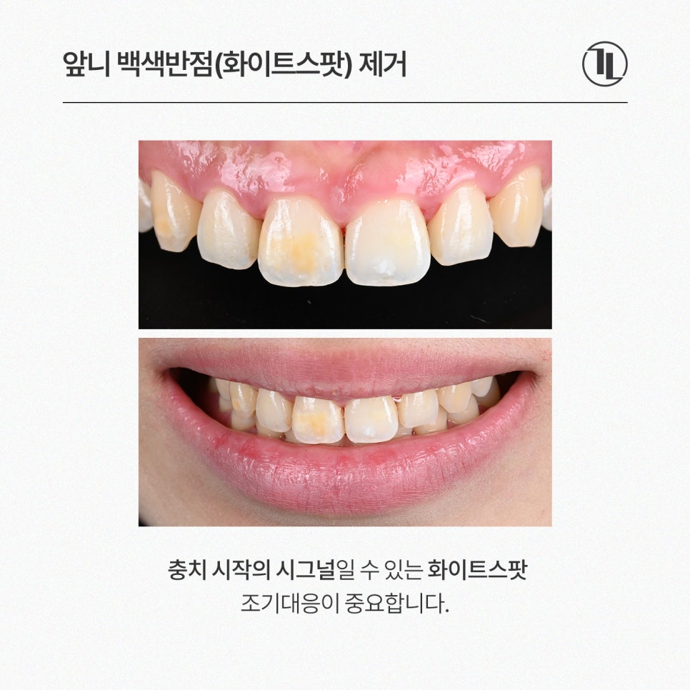 앞니 하얀얼룩 반점치 하루만에 치료, 원인과 사례까지! / 강남레옹치과 관련 이미지 2