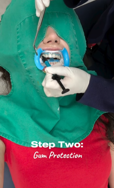 강남레옹치과 뉴티스 치아미백 Vlog📽️ | 치아미백 효과, 유지기간, 부작용 총정리! 관련 이미지 8