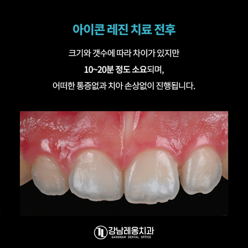 앞니 하얀점, 앞니 반점치 삭제없이 치료! / 아이콘 레진 치료 / 강남레옹치과 관련 이미지 10