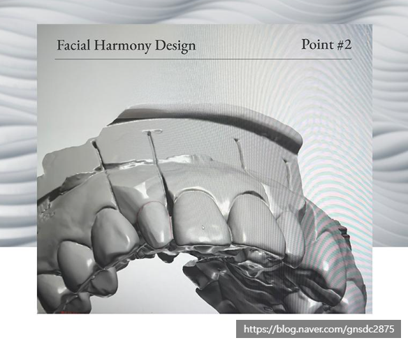 치아파절 개선방법, 뉴티스라미✨ / 강남레옹치과 관련 이미지 7