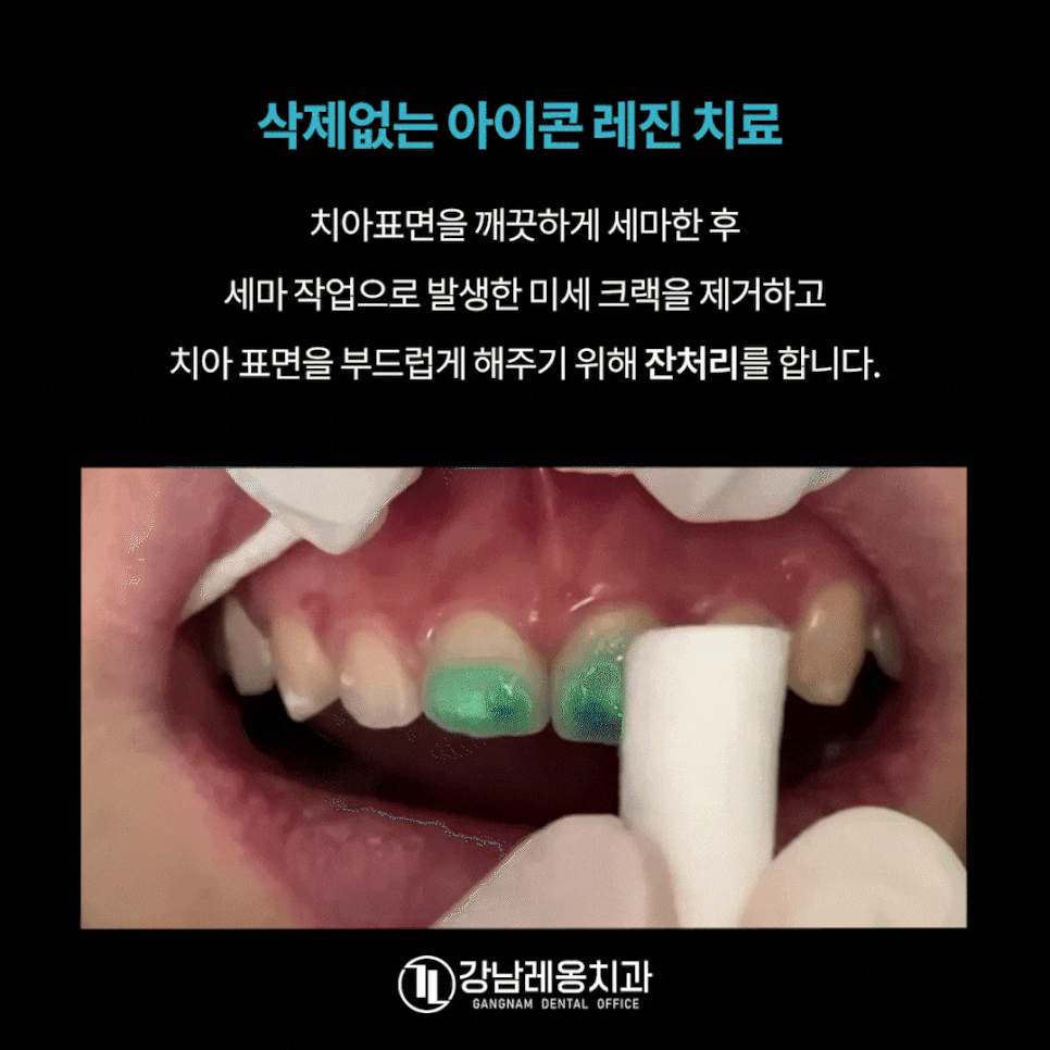 앞니 하얀점, 앞니 반점치 삭제없이 치료! / 아이콘 레진 치료 / 강남레옹치과 관련 이미지 8