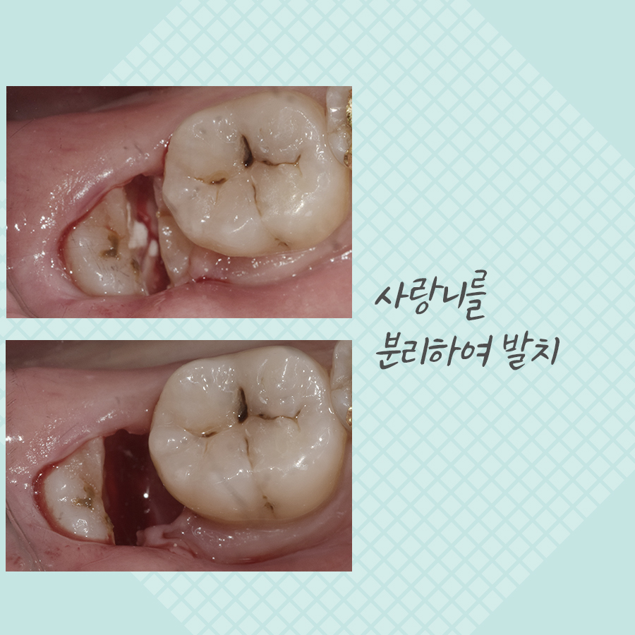 매복 사랑니발치 비용, 강남레옹치과 증례를 보며 알아봐요. 관련 이미지 4
