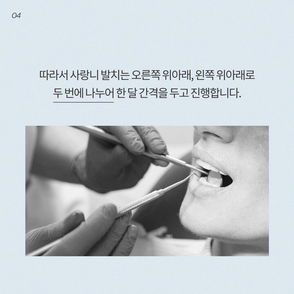 사랑니 4개 발치, 하루에 한번에 가능할까요? - 강남레옹치과 답변 관련 이미지 4