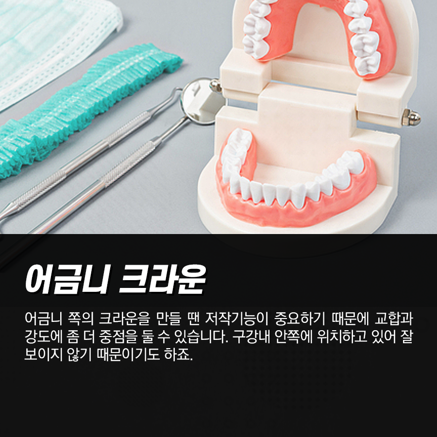 앞니 라미네이트 올세라믹 크라운 가격. 왜 어금니보다 비싼가?? 관련 이미지 3