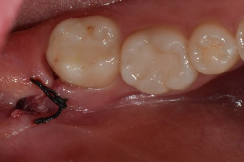 사랑니 발치 후 관리 & 회복 과정 한 눈에 보기👀! / 강남레옹치과 관련 이미지 4