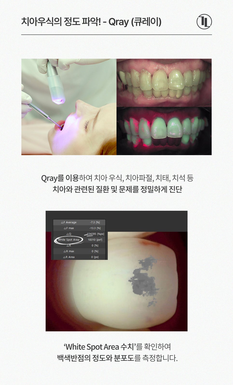 앞니 하얀얼룩 반점치 하루만에 치료, 원인과 사례까지! / 강남레옹치과 관련 이미지 3