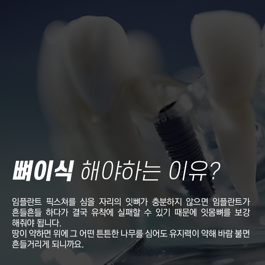 강남역 임플란트 뼈이식 하기 싫어도 해야 되는 이유 관련 이미지 2