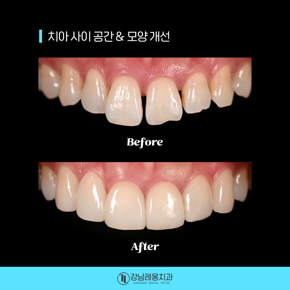 최소삭제 라미네이트 &lsquo;뉴티스&rsquo;의 시술 후 관리방법은? / 양치질, 치실 사용방법 / 강남레옹치과 관련 이미지 3