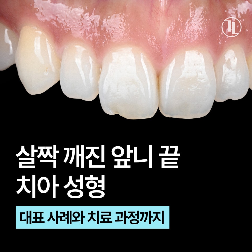 살짝 깨진 앞니 끝, 치아성형으로 고르게 다듬기 / 강남레옹치과 관련 이미지 1