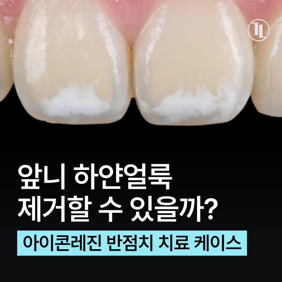 앞니 하얀 얼룩, 반점치 치료 케이스 / 아이콘레진 치료 방법 / 강남레옹치과 관련 이미지 1