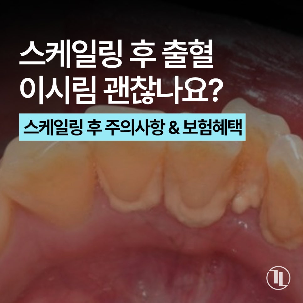 치아 스케일링 후 이시림 / 식사는? / 강남레옹치과 관련 이미지 1