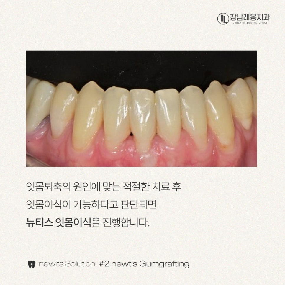 뉴티스 잇몸이식✨ 잇몸퇴축, 치아뿌리를 보호하고 심미적 개선 / 강남레옹치과 관련 이미지 2