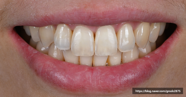 앞니에 하얀얼룩이? 앞니 길이가 달라요! / 앞니통합치료 뉴티스 반점치료 + 치아성형✨ / 강남레옹치과 관련 이미지 9